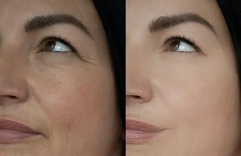 Traitements de problématique de peau avec laser