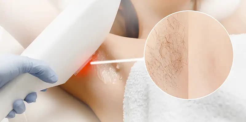 Épilation définitive